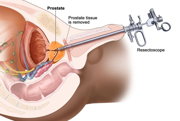 Prostatectomy