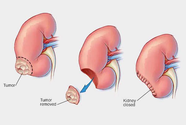 Kidney Cancer