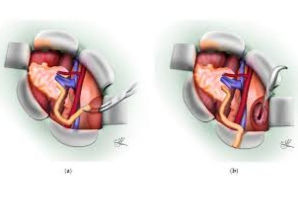 Renal Transplant Surgery