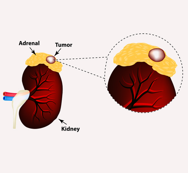 Adrenal Cancer